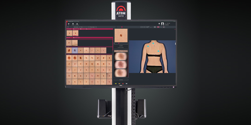 Fotofinder Bodystudio ATBM® master und künstliche Intelligenz (KI) für die Hautkrebsfrüherkennung.